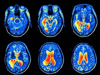 Magnetic Resonance Imaging May Help Identify Suicide Risk